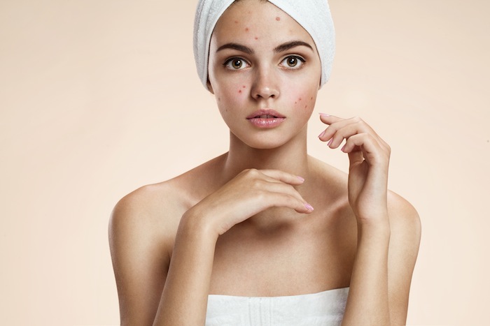 Acne Treatment