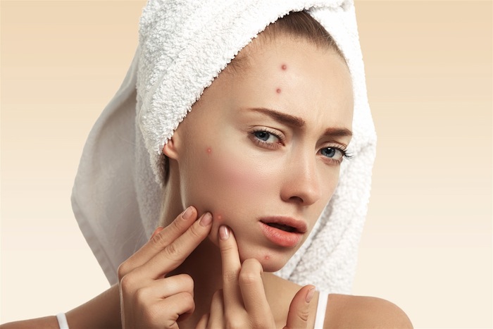 Acne Problem